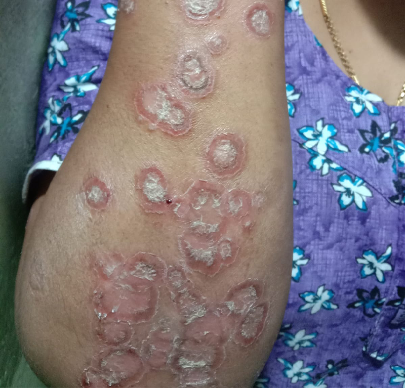 Psoriasis Treatment