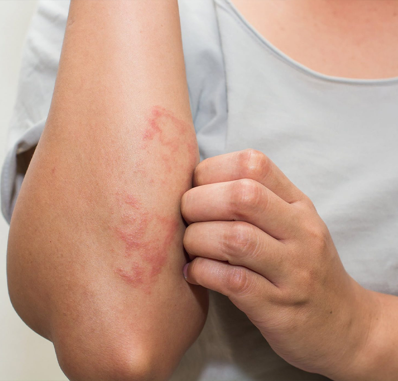 Eczema Treatments
